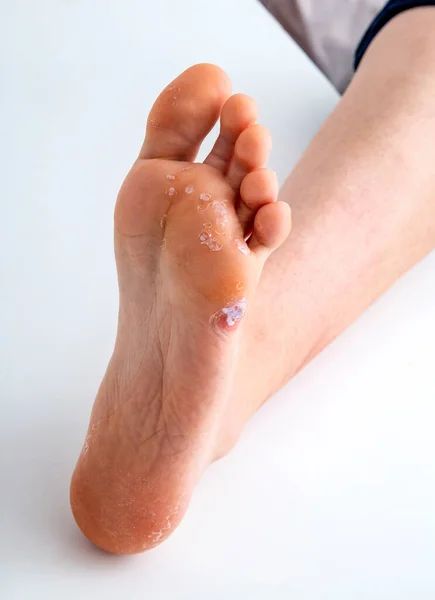 人間の足の上の足のトウモロコシ — ストック写真