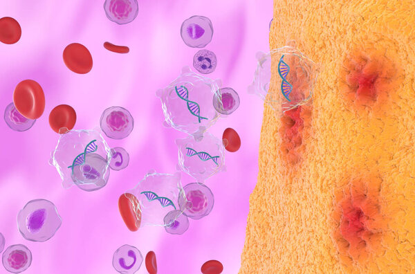 Gene therapy in Rheumatoid arthritis - isometric view 3d illustration
