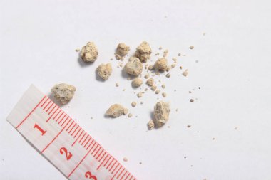 düz yatıyordu veya en iyi görünüm çok küçük böbrek taşı cetvelde beyaz arka plan ile