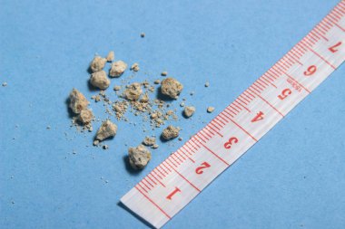 düz yatıyordu veya en iyi görünüm çok küçük böbrek taşı ile mavi arka plan, cetvel