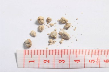 Beyaz arka plan, düz yatıyordu veya en iyi görünüm çok küçük böbrek taşı