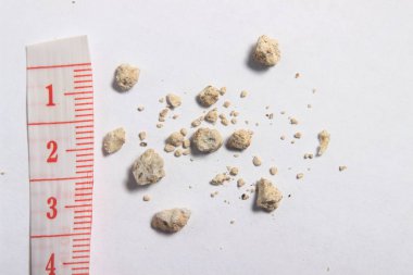 Beyaz arka plan, düz yatıyordu veya en iyi görünüm çok küçük böbrek taşı