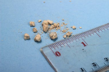 düz yatıyordu veya en iyi görünüm çok küçük böbrek taşı ile mavi arka plan, cetvel