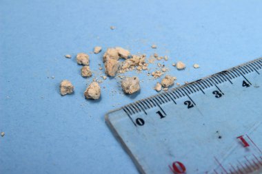 düz yatıyordu veya en iyi görünüm çok küçük böbrek taşı ile mavi arka plan, cetvel