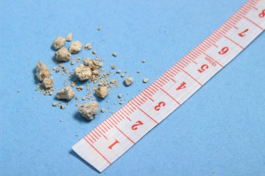 düz yatıyordu veya en iyi görünüm çok küçük böbrek taşı ile mavi arka plan, cetvel