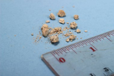 düz yatıyordu veya en iyi görünüm çok küçük böbrek taşı ile mavi arka plan, cetvel