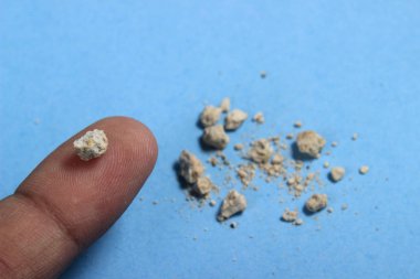 düz yatıyordu veya en iyi görünüm çok küçük Böbrek taşına parmak mavi arka plan