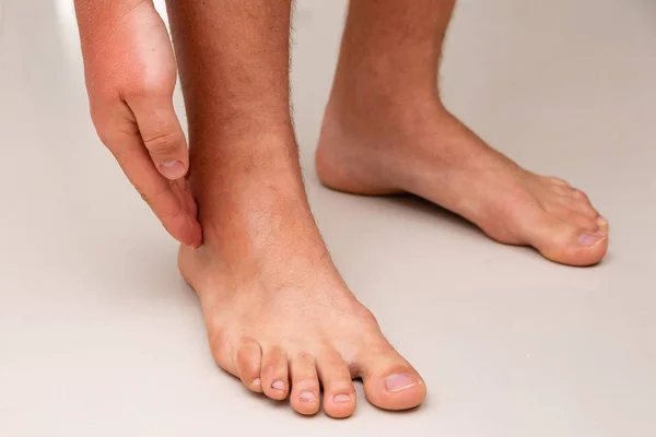 Swollen leg after ankle sprain — Stock Photo, Image