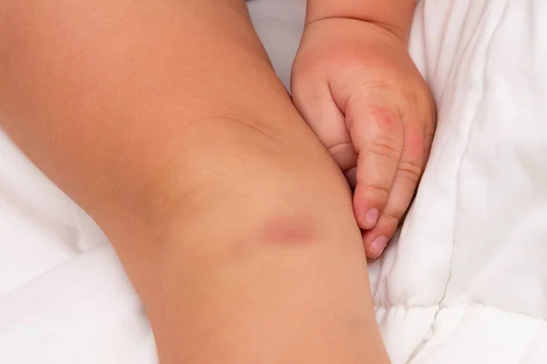 Grote blauwe plekken op de knie van de baby — Stockfoto