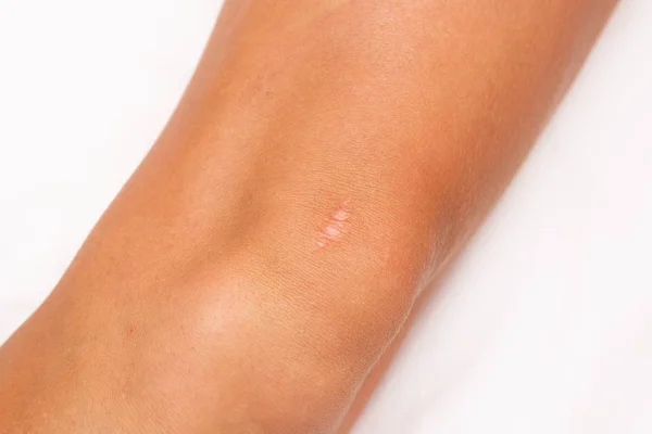 Cicatriz na perna de uma mulher — Fotografia de Stock