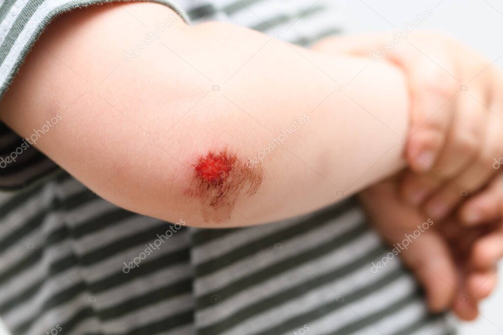 boy kid arm accident wound he painful abrasion scratches from fall, medical health concept