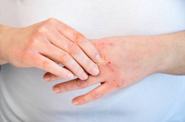 Woman checking the hand with very dry skin and deep cracks clipart