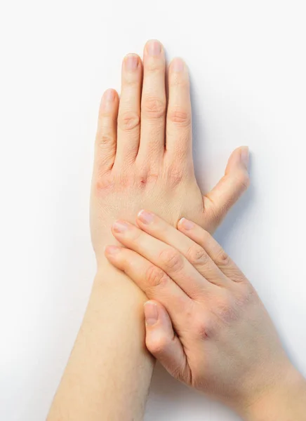 Mulher Verificando Mão Com Pele Muito Seca Rachaduras Profundas — Fotografia de Stock