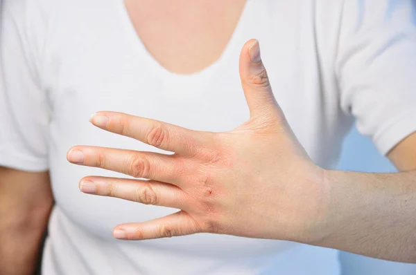 Γυναίκα Ελέγχοντας Χέρι Πολύ Ξηρό Δέρμα Και Τις Βαθιές Ρωγμές — Φωτογραφία Αρχείου