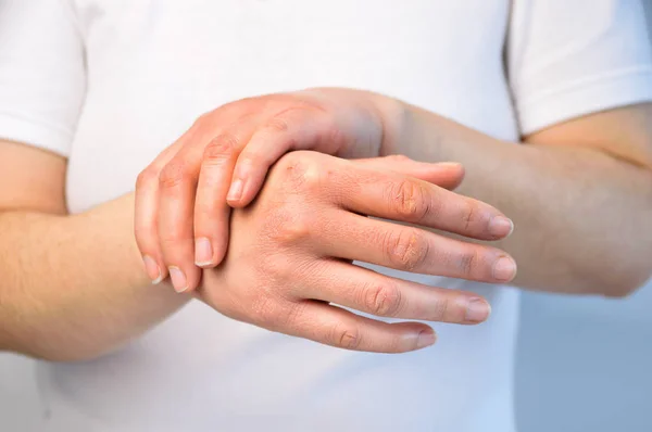 Mulher Verificando Mão Com Pele Muito Seca Rachaduras Profundas — Fotografia de Stock