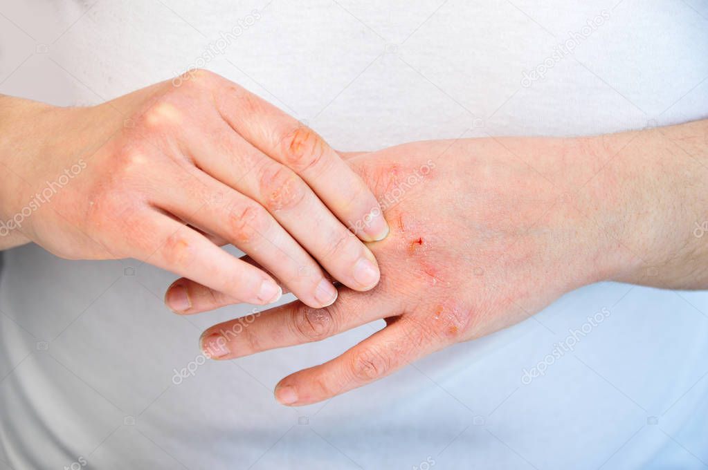 Woman checking the hand with very dry skin and deep cracks