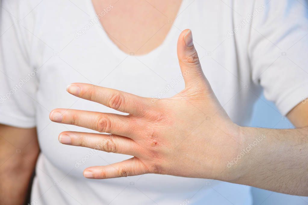 Woman checking the hand with very dry skin and deep cracks