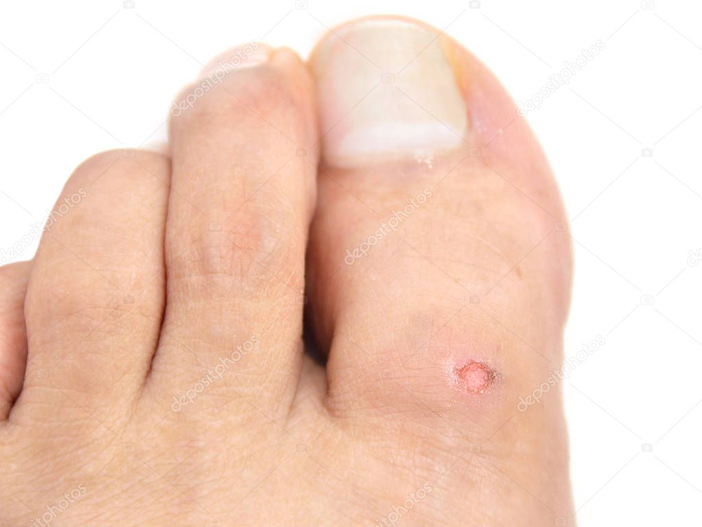 wound on a toe by the shoe rubbing with white backgroun