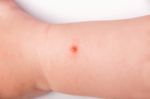 Mückenstiche Wund Und Narbe Kinderarm — Stockfoto