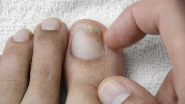 Homem Adulto Coçando Dedo Com Fungo Toalha Branca Sair Piscina — Vídeo de Stock