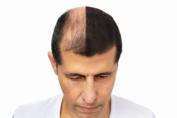 Mężczyzna Przed Leczeniu Wypadania Włosów Białym Tle — Zdjęcie stockowe