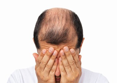 Close-uo of bald man stressed by rapid hair loss against a white background clipart