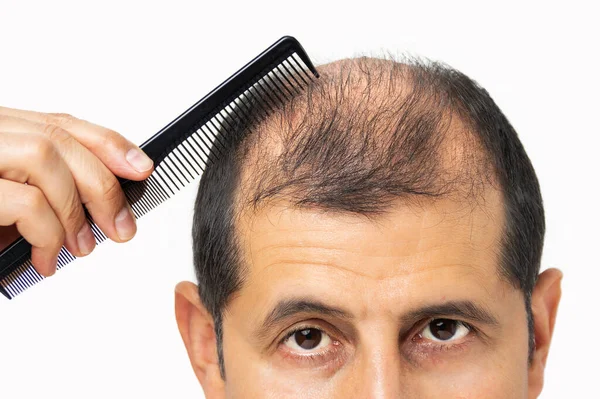 Humant Alopeci Eller Håravfall Vuxen Man Hand Hålla Kam Skalligt — Stockfoto