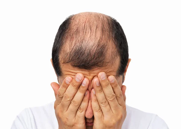 Close Plešatého Muže Zdůraznil Rychlé Vypadávání Vlasů Bílém Pozadí — Stock fotografie