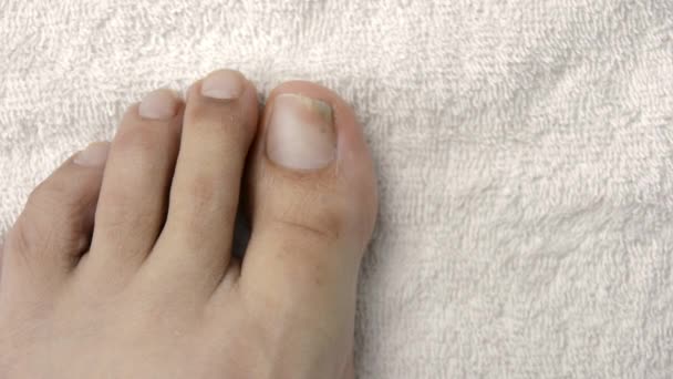 Homem Adulto Coçando Examinando Dedo Com Fungo Toalha Branca Sair — Vídeo de Stock