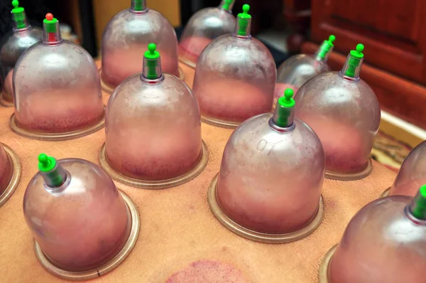 Cupping Bekam Hijamah Tratamiento Tradicional — Foto de Stock