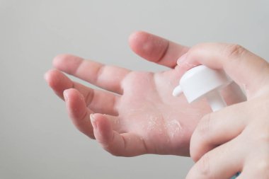 The picture shows symptoms of peeling hands affected by the use of alcohol gel to kill coronavirus.