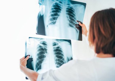 Kadın doktor, hastanedeki radyoloji bölümünde iki hastanın göğüs röntgeni film ciğerlerini karşılaştırıyor. Akciğer bozuklukları ya da Covid-19 röntgen taraması. Covid virüs salgını konsepti.