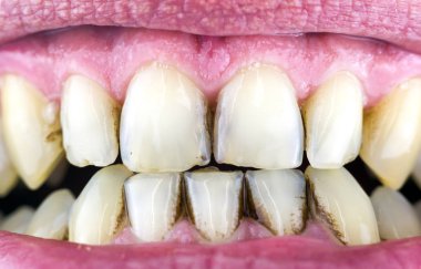 Dişlerde Dental plak