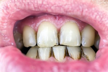 Dişlerde Dental plak