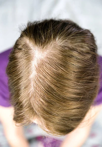 Hair loss female — Stock Photo, Image