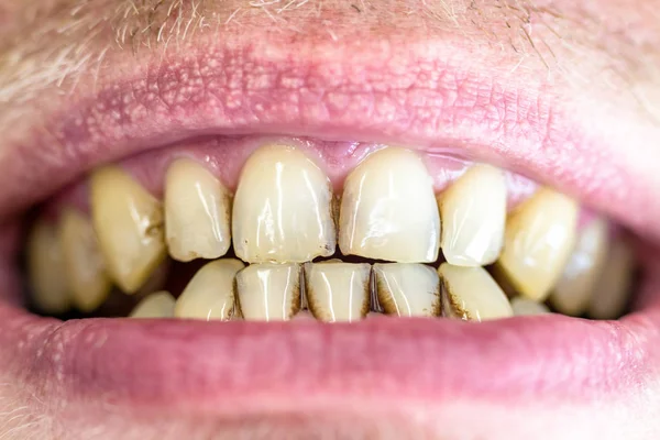 Tandplaque op gele tanden — Stockfoto
