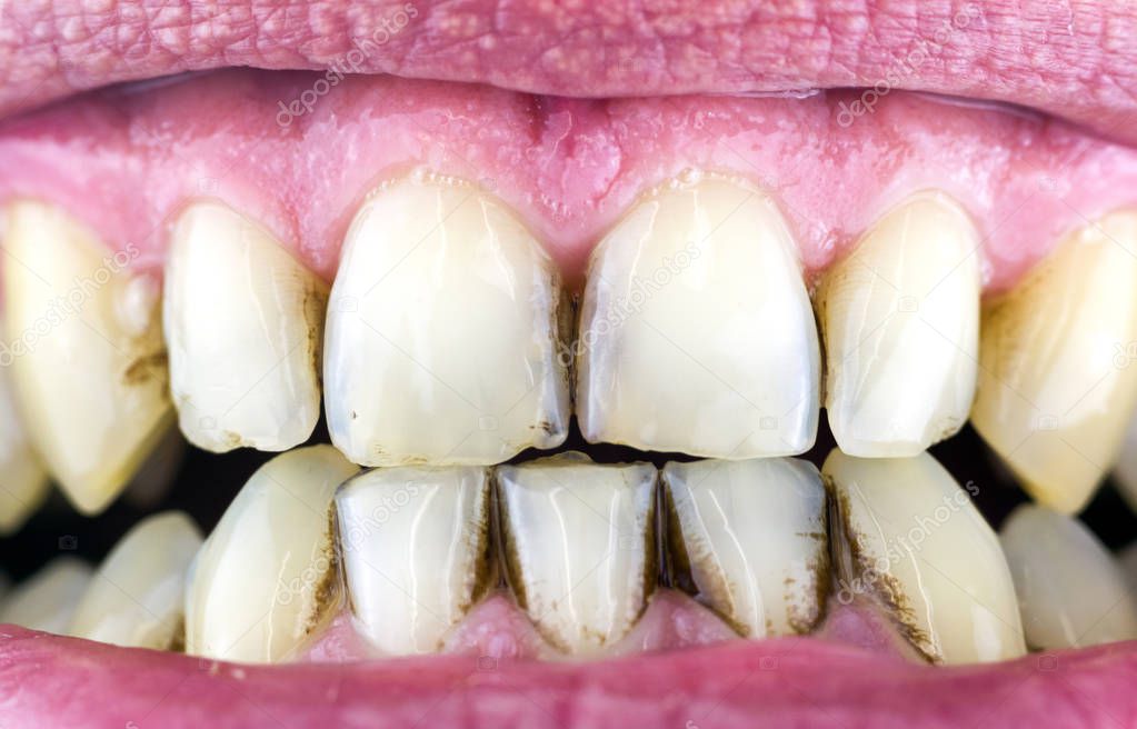 Dental plaque on teeth