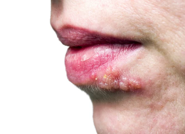 Herpes op de lip — Stockfoto