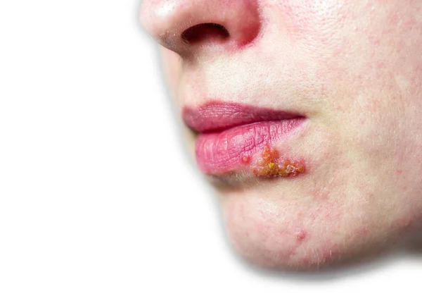 Herpes op de lip — Stockfoto