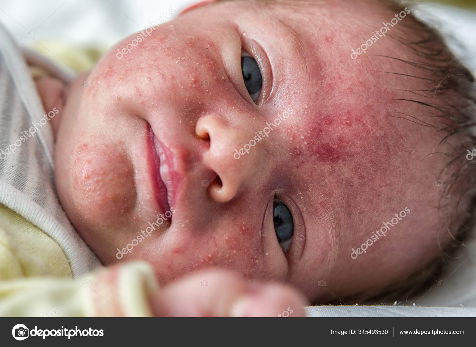Baby acne face Stock Photo by ©jarino 315493530