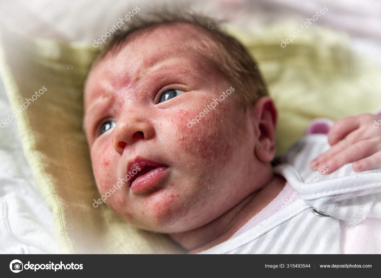 Armoedig landinwaarts pil Baby acne on face Stock Photo by ©jarino 315493544