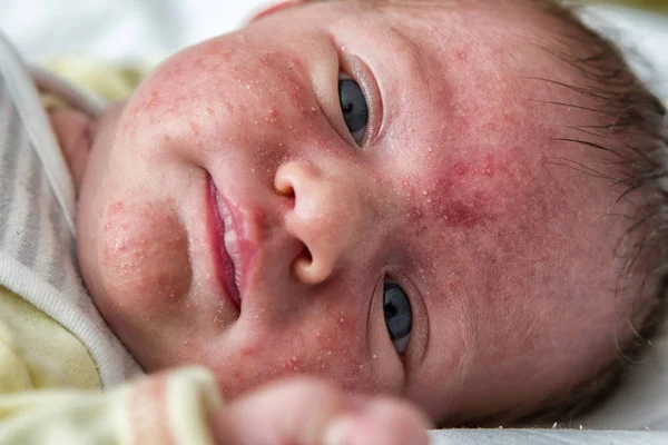 Baby acne op het gezicht — Stockfoto