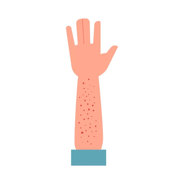 Menschliche Hand betroffen kleiner roter Ausschlag - Symptom einer Allergie oder eines Ekzems isoliert auf weißem Hintergrund. — Stockvektor