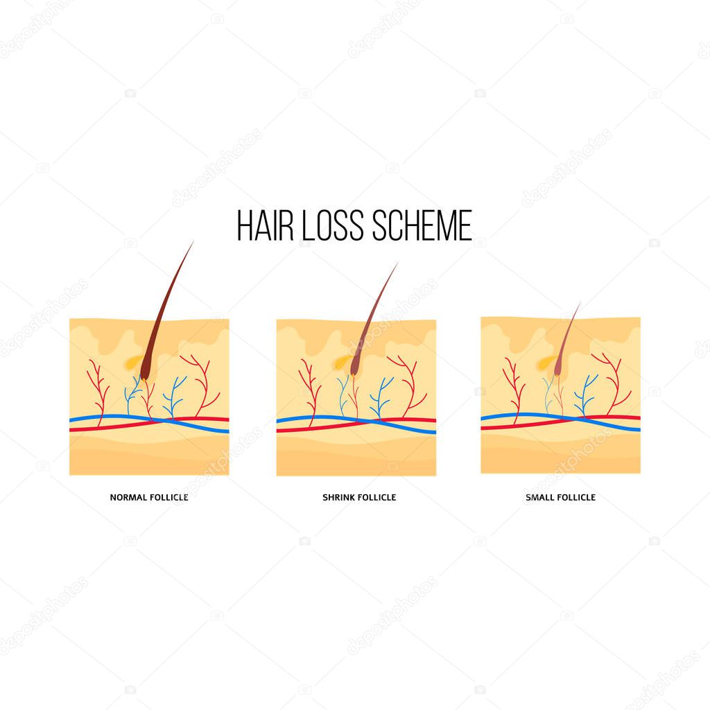 Human hair loss scheme flat style
