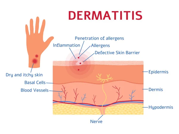 Diagrama gráfico Dermatite ou esquema de estilo plano —  Vetores de Stock