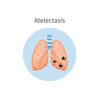 Atelectasis a medical scheme of lung disease vector illustration isolated. clipart