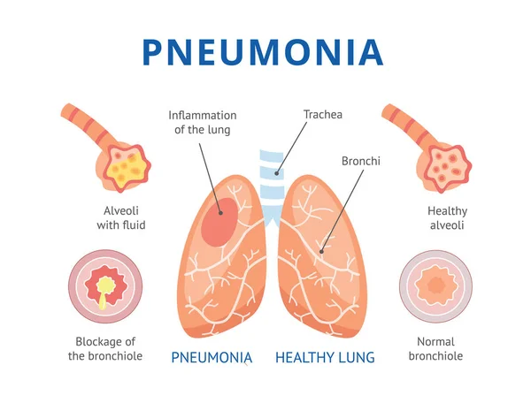 The lungs are healthy and diseased lungs with pneumonia. — Stock Vector