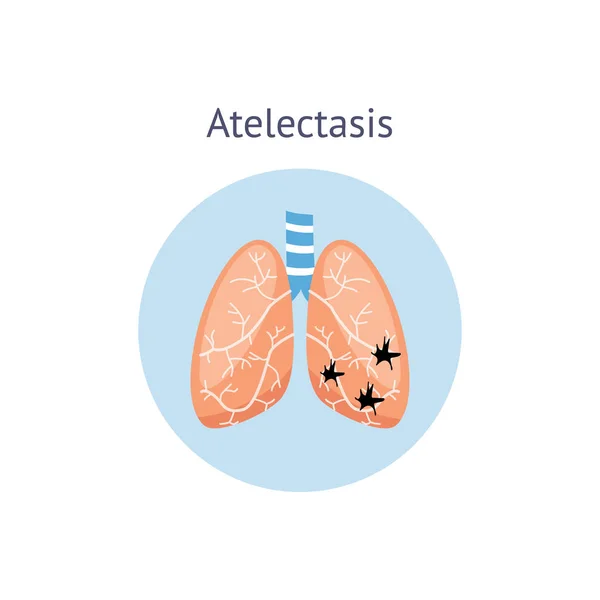 Atelectasis medycznych schemat choroby płuc ilustracja na białym tle. — Wektor stockowy