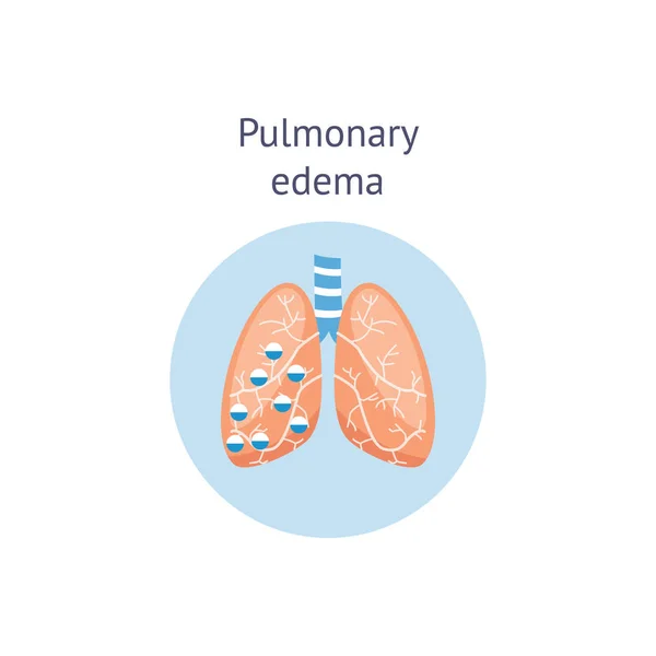 Œdème pulmonaire un schéma de médecine des maladies pulmonaires illustration vectorielle isolé . — Image vectorielle