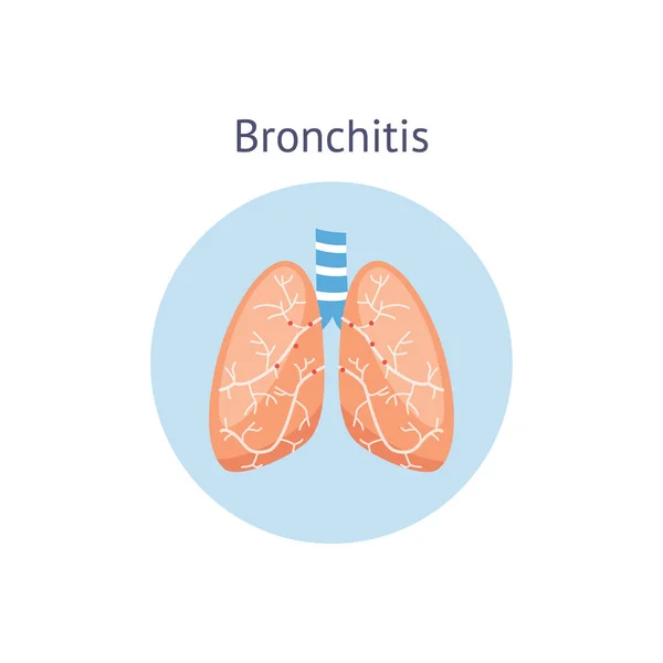 Бронхіт хвороба легенів медична анатомічна діаграма Векторні ілюстрації ізольовані . — стоковий вектор